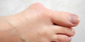 Hallux-valgus (monturile) Hallux-valgus (monturile)
