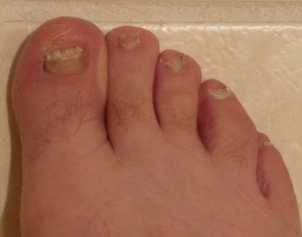 Infectia fungica a unghiei