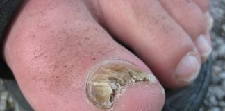 Infectia fungica a unghiei – Simptome si metode de tratament Infectia fungica a unghiei - Simptome si metode de tratament