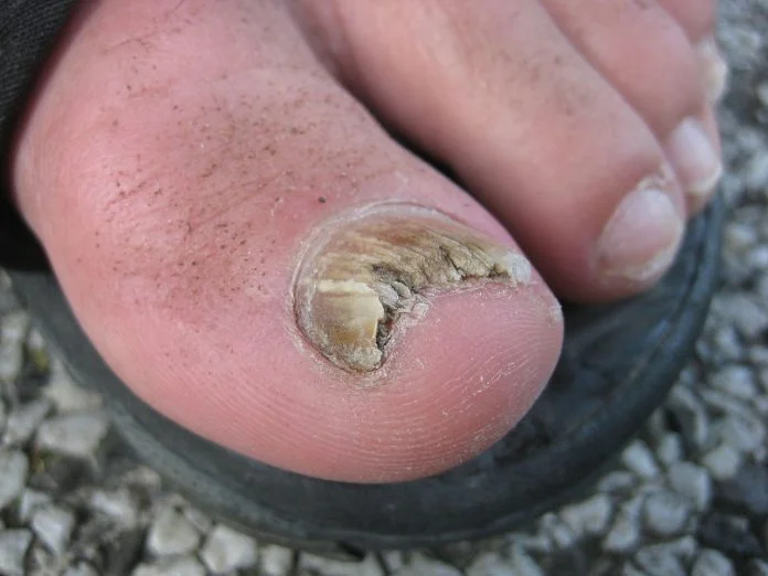 Infectia fungica a unghiei - Simptome si metode de tratament
