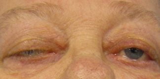 Miastenia gravis sau slabiciune musculara Miastenia gravis sau slabiciune musculara