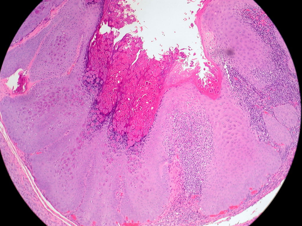 Molluscum Contagiosum