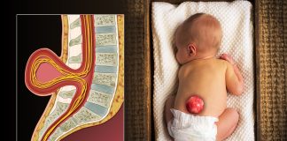 Spina bifida sau coloana deschisa, o malformatie a fatului in curs de dezvoltare Spina bifida sau coloana deschisa, o malformatie a fatului in curs de dezvoltare