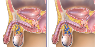 Varicocelul provoaca infertilitatea masculina