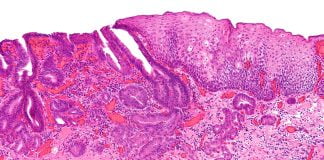 Arsurile de esofag datorate alimentatiei, surmenajului si stresului