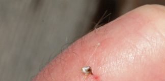 Cum tratam intepatura de albina? Cum tratam intepatura de albina