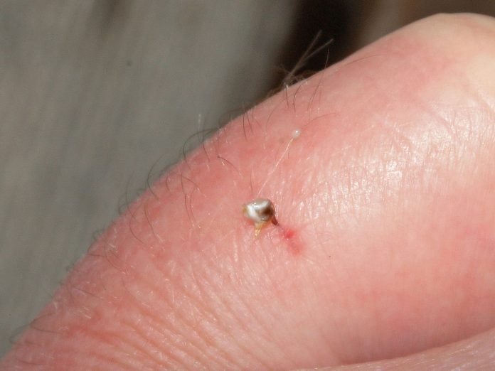 Cum tratam intepatura de albina Cum tratam intepatura de albina