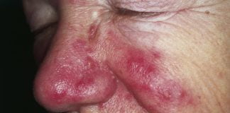 Rozaceea sau acneea rozacee – Cauze, simptome, tratament