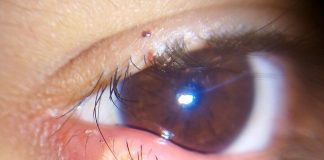 Orjeletul (urciorul) si salazionul – Cauze, simptome si metode de tratament