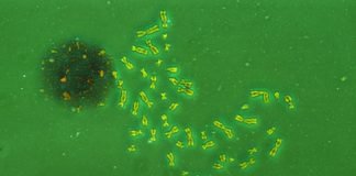 Afla ce este sindromul Klinefelter, cauze, simptome si metode de tratament