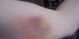 Cum tratam vanataile si contuziile folosind cele mai eficiente remedii populare