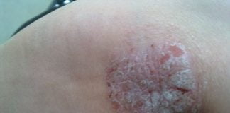 Remedii naturale eficiente pentru coate uscate