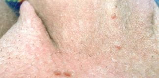 Afla totul despre vegetatiile veneriene, verucile virale, negii comuni si verucile genitale