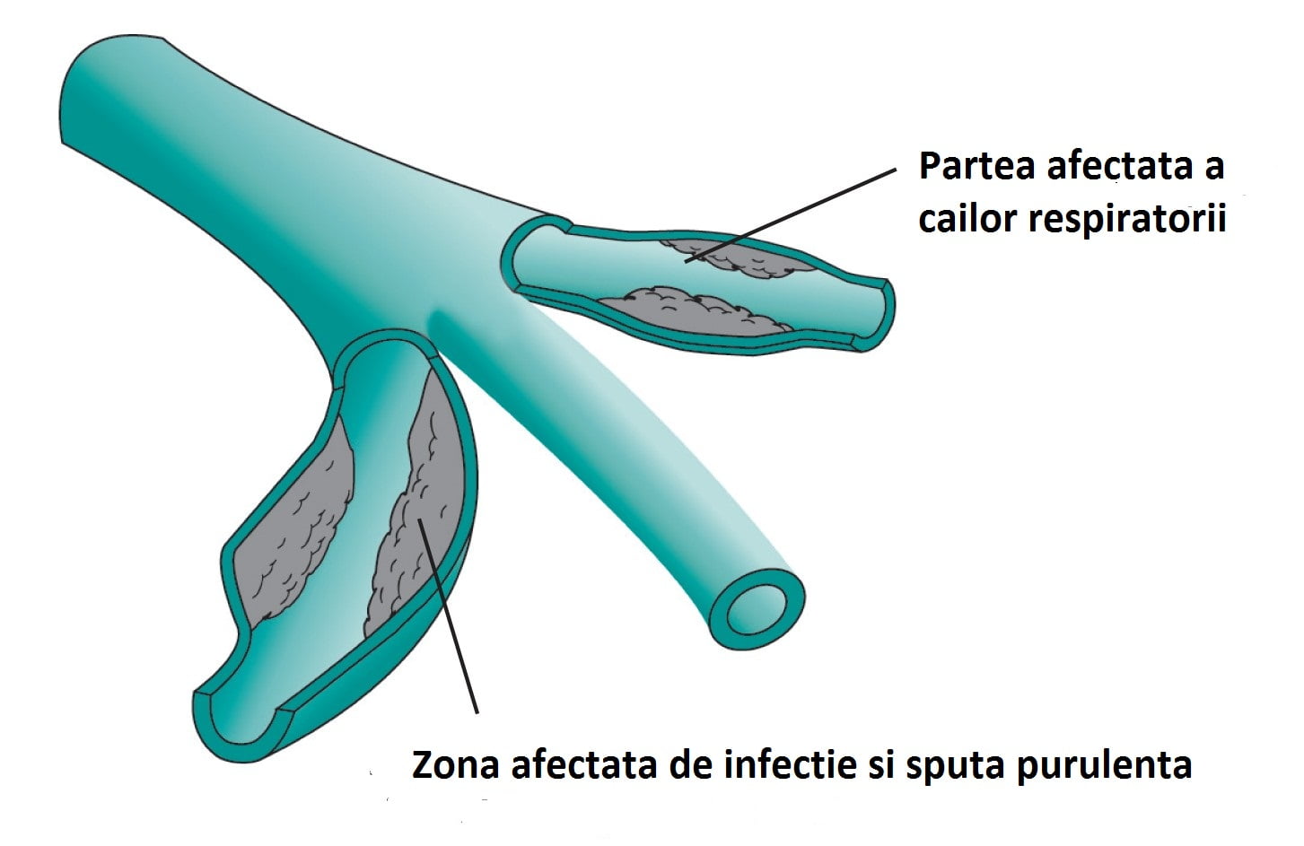 Boala