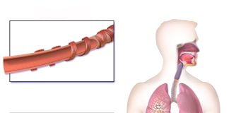 Ce simptome are bronsiectazia si cum se manifesta aceasta boala grava a plamanilor