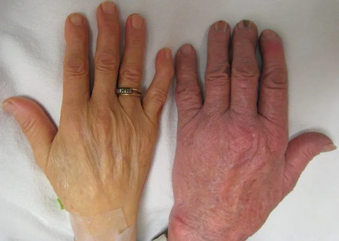 Cum tratam anemia si crestem nivelul de hemoglobina din sange