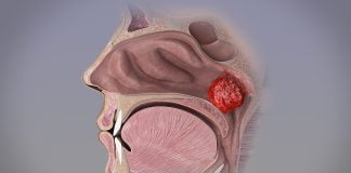Descopera principalele remedii populare pentru tratamentul vegetatiilor adenoide ce sunt o sursa de infectie a nasului!