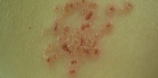 Afla cum se formeaza si cum poti trata veziculele - basici cu apa