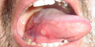 Ce sunt aftele si care sunt cele mai eficiente metode pentru vindecarea lor