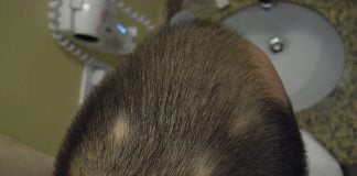 Cum apare si cum tratam alopecia – caderea parului sau calvitia