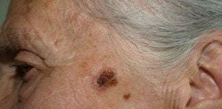 Ce este vaccinul impotriva cancerului de piele si cum actioneaza acesta