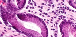 Cum recunoastem gastrita, care sunt cauzele si tratamentul ei