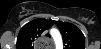 Cum se manifesta achalazia si cum se trateaza aceasta boala rara a esofagului