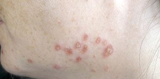 Stiati ca bolile de piele se agraveaza in timpul iernii