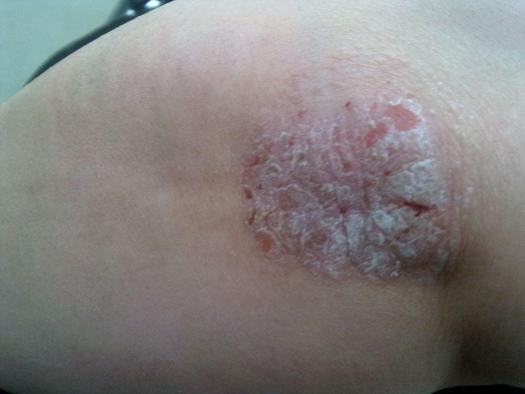 Psoriazis