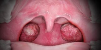 Scapa de inflamarea amigdalelor cu ajutorul remediilor populare Scapa de inflamarea amigdalelor cu ajutorul remediilor populare