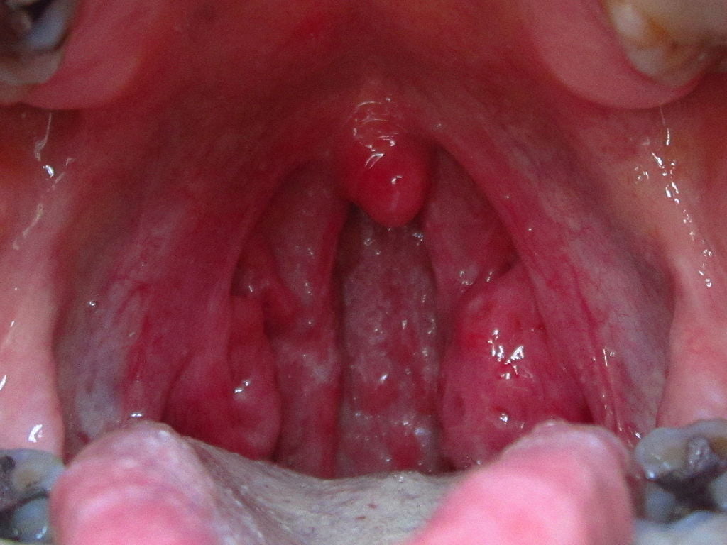 inflamarea amigdalelor