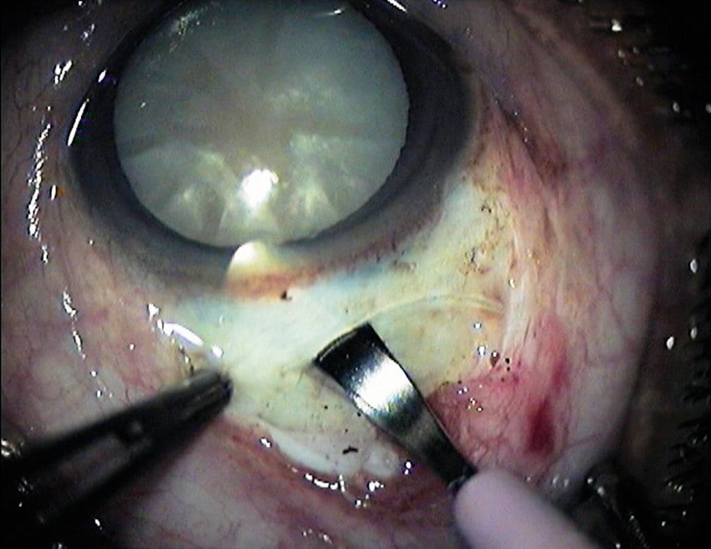 cataracta chirurgical