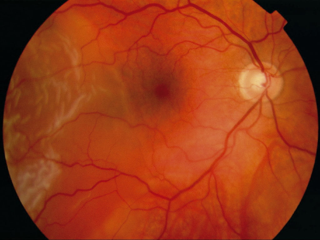 infarctul retinian