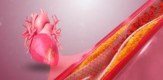 Aparitia bolilor cardiovasculare este cauzata de nivelul ridicat de colesterol din sange Aparitia bolilor cardiovasculare este cauzata de nivelul ridicat de colesterol din sange