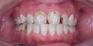 Cum se formeaza caria dentara si care sunt optiunile de prevenire si tratament Cum se formeaza caria dentara si care sunt optiunile de prevenire si tratament