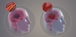 Atacul cerebral poate duce la deformari fizice
