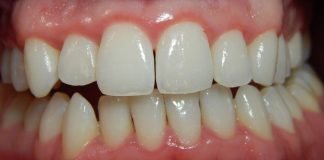 Ai grijă de gingiile tale, astfel poți preveni pierderea dinților