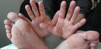 Boala mână-picior-gură, infecția cu virusul Coxsackie la copii Boala mână-picior-gură, infecția cu virusul Coxsackie la copii