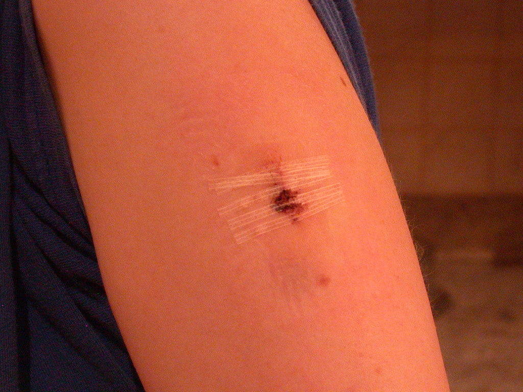 Cum se elimină alunițele