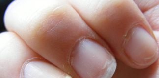 Lipsa de vitamine afectează starea unghiilor Lipsa de vitamine afectează starea unghiilor