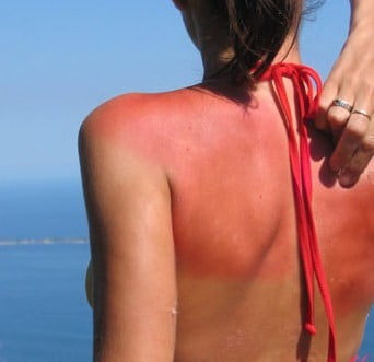 Alergii solare