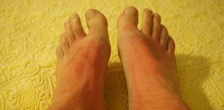 Poți preveni alergiile solare dacă nu te expui prea mult la soare