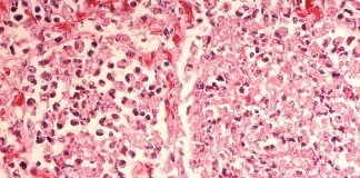 Boala legionarului, o infecție gravă a plămânilor