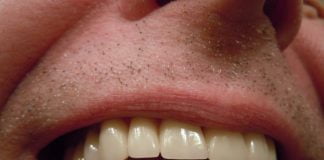Bruxism sau scrâșnit din dinți, o problemă dentară cauzată de stres
