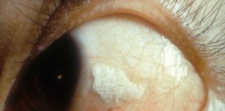 De ce apar pete albe pe ochi sau pete Bitot? De ce apar pete albe pe ochi sau pete Bitot