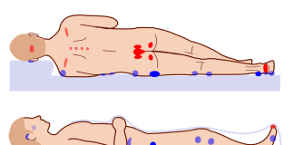 Ce sunt escarele și de ce apar? Metode de prevenire a escarelor de decubit Ce sunt escarele și de ce apar Metode de prevenire a escarelor de decubit