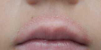 Buzele crăpate și dureroase – Semn al deshidratarii sau infecție fungică