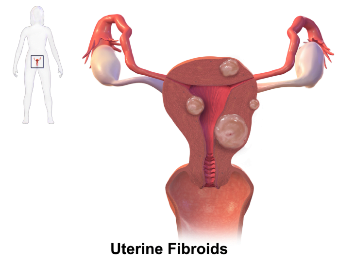 8 simptome și semne ce anunță fibromul uterin care nu trebuie neglijate 8 simptome și semne ce anunță fibromul uterin care nu trebuie neglijate