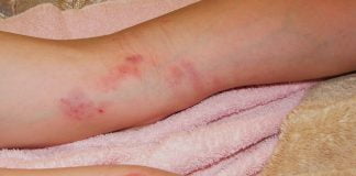 Echimoza, motiv de îngrijorare? Iată care sunt cele mai frecvente cauze ale echimozelor Echimoza, motiv de îngrijorare Iată care sunt cele mai frecvente cauze ale echimozelor