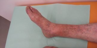 Tromboflebita – recomandări și remedii naturiste pentru tratament Tromboflebita - recomandări și remedii naturiste pentru tratament
